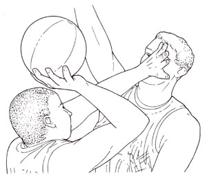 バスケットボール時の保護眼鏡は大変重要
